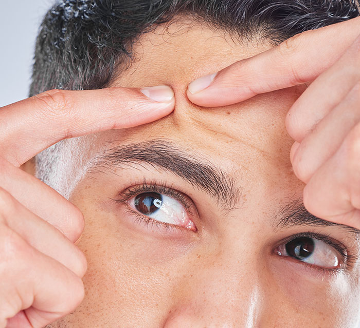 Close-up of a man attempting to pop a pimple on his forehead related to self diagnosis and skin concerns.