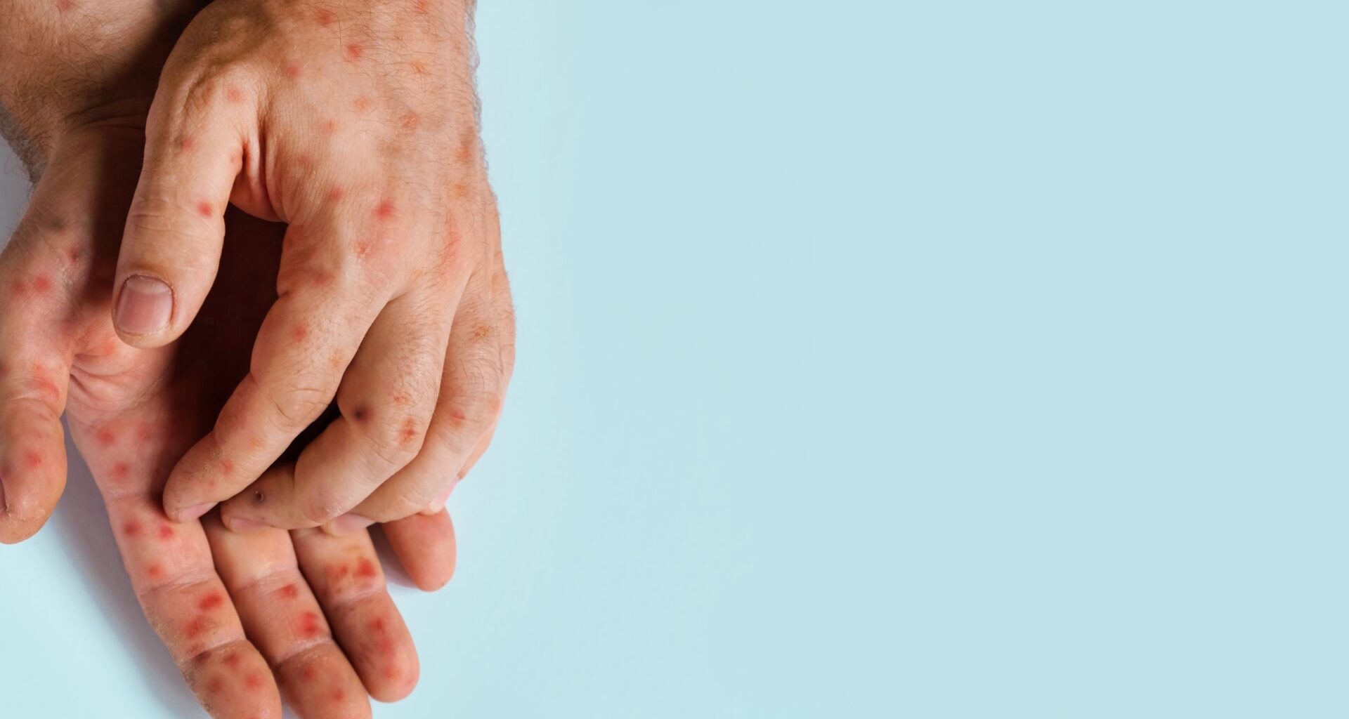 Canada loses measles-free status amid nationwide outbreak