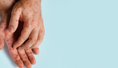 Canada loses measles-free status amid nationwide outbreak