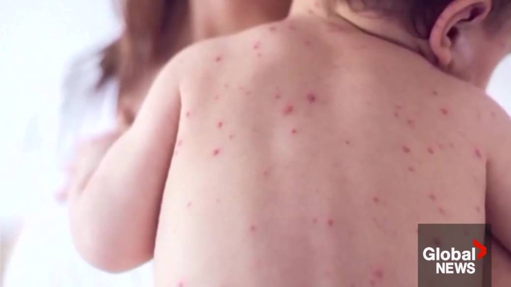 Click to play video: 'Alberta reaction to Canada losing measles elimination status'