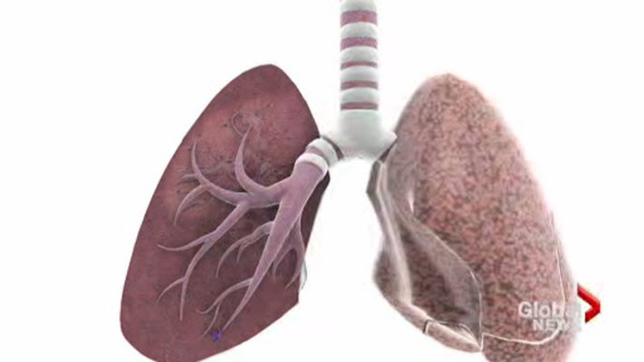 Click to play video: 'Analyzing the risks of tuberculosis'