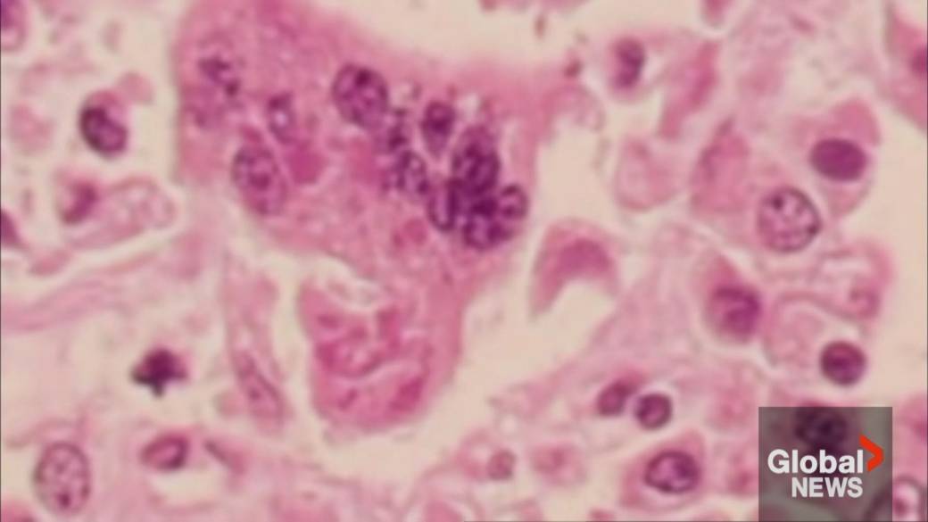 Click to play video: 'Canada loses measles elimination status'