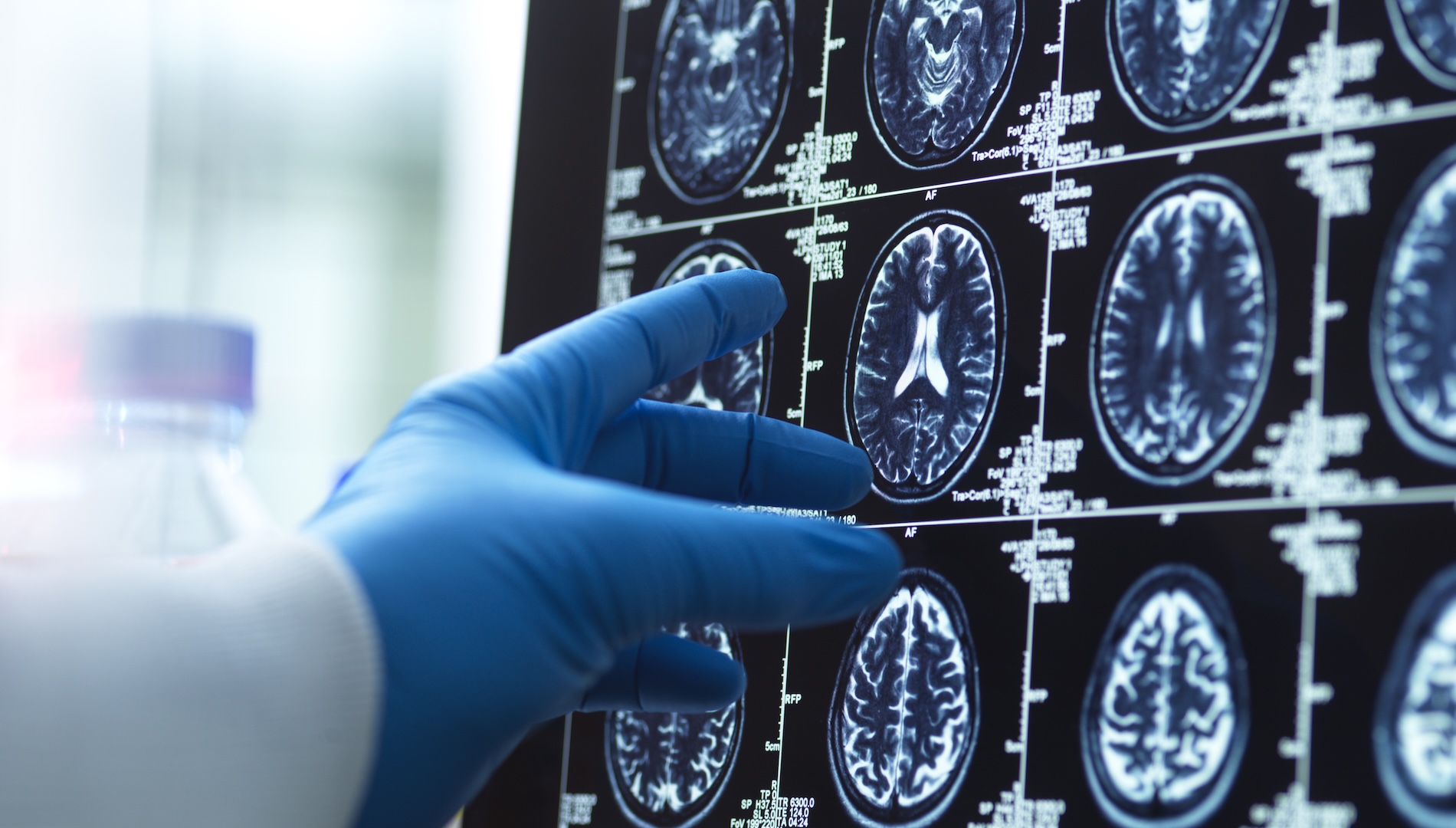gloved hand pointing at brain scans on a screen