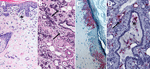 Histopathologic findings and detection of Lassa virus (LASV) antigens and RNA in mammary tissues by immunohistochemistry (IHC) and in situ hybridization (ISH) in strain 13/N guinea pigs lethally infected with LASV strain Josiah in study of guinea pig model for LASV infection of reproductive tract and considerations for sexual and vertical transmission. A) Mammary skin (23 dpi), hemotoxylin and eosin stain. Mild interstitial lymphoplasmacytic infiltrates and edema (asterisk) in the superficial dermis. B) Mammary gland (25 dpi), hemotoxylin and eosin stain. Mild interstitial lymphoplasmacytic infiltrates (arrows) in the periglandular stroma. C) Mammary skin (23 dpi), IHC. Staining in keratinocytes of the epidermis. D) Mammary gland (23 dpi), ISH. Staining around vessels and within the stroma between glands (arrow) and within cells in a mammary duct lumen (asterisk). Original magnifications ×10 (panels A–C), ×20 (panel D).