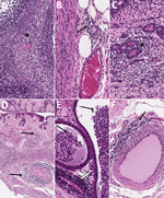 Histopathologic findings in reproductive tissues from strain 13/N guinea pig survivors of Lassa virus strain Josiah infection at 42 days postinfection (dpi) in study of guinea pig model for Lassa virus infection of reproductive tract and considerations for sexual and vertical transmission. Panels A–D depict samples from female guinea pigs; panels E–F depict male samples from male guinea pigs. A) Ovary (42 dpi) with lymphoplasmacytic inflammation in the stroma (asterisk). B) Oviduct (42 dpi) with focal perivascular and interstitial inflammation (arrow). C) Uterus (42 dpi) with endometrial stromal lymphoplasmacytic inflammation (asterisk) around glands. D) Vagina (42 dpi) with lymphocytic inflammation (arrows) around vessels in the vaginal wall. E) Epididymis (42 dpi) with dense perivascular lymphoplasmacytic inflammation around a vessel (white arrow) and heterophils within tubular lumens (black arrows). F) Penile connective tissue (42 dpi) with perivascular lymphocytic inflammation (arrow). Hemotoxylin and eosin stain. Original magnification ×40.