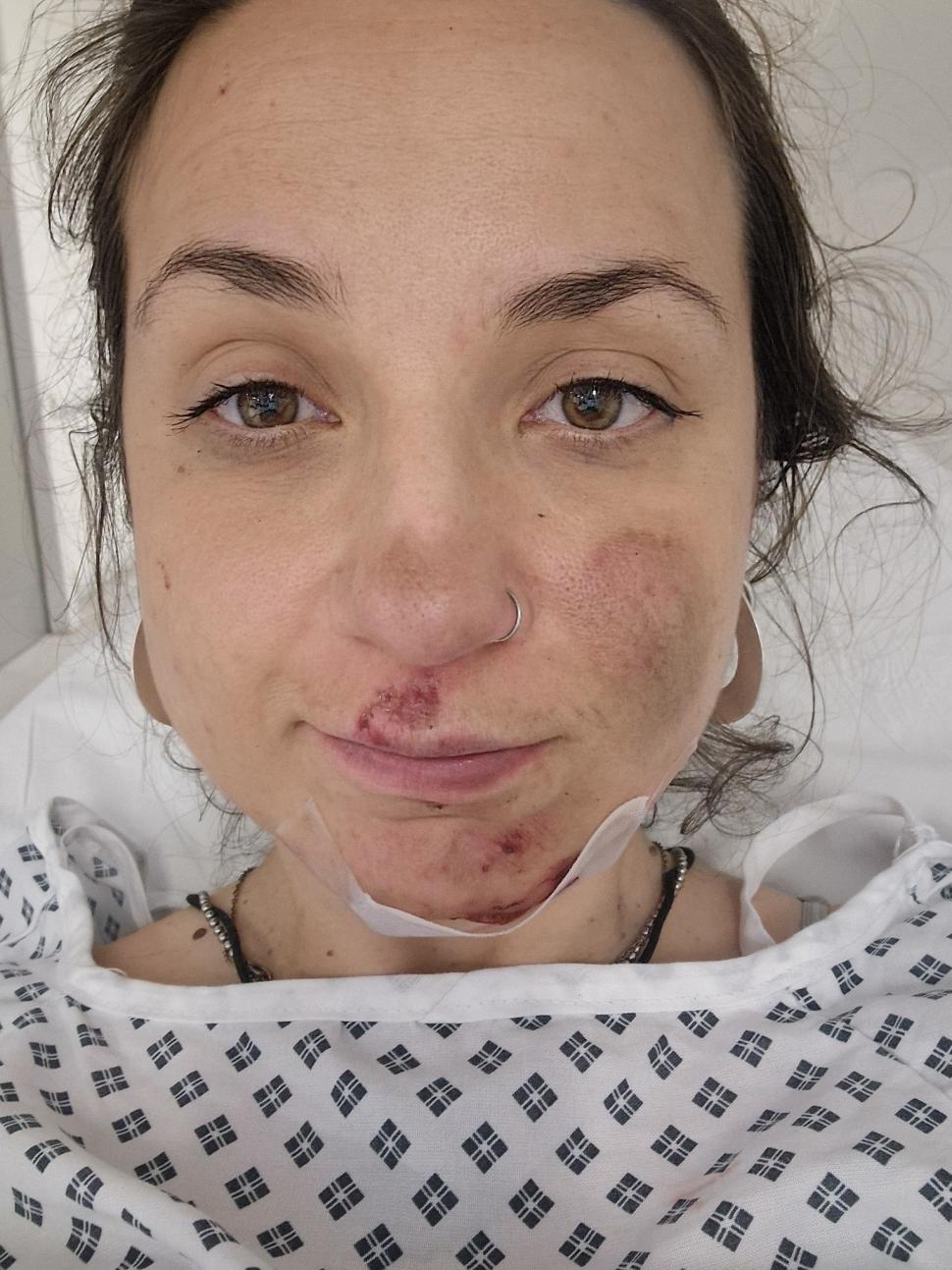 Cyclist Alexia Hall in hospital after crashing following a close pass by a driver in Tunbridge Wells