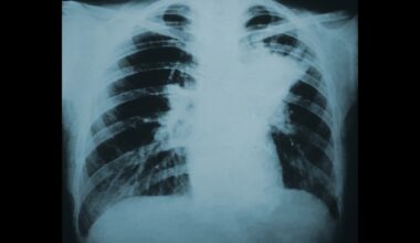 Sudbury health board addresses deadly Northern Ontario fungal outbreak