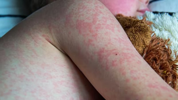 New measles uptick 'alarming,' Alberta doctor warns
