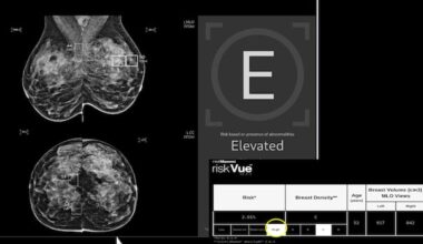 Using AI to read mammograms cut risk of developing aggressive breast cancer, study finds