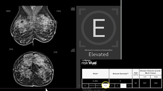 Using AI to read mammograms cut risk of developing aggressive breast cancer, study finds
