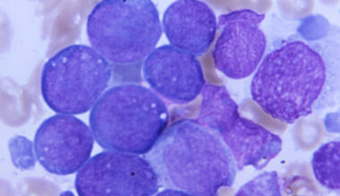 Genetic variant appears to protect against blood cancers