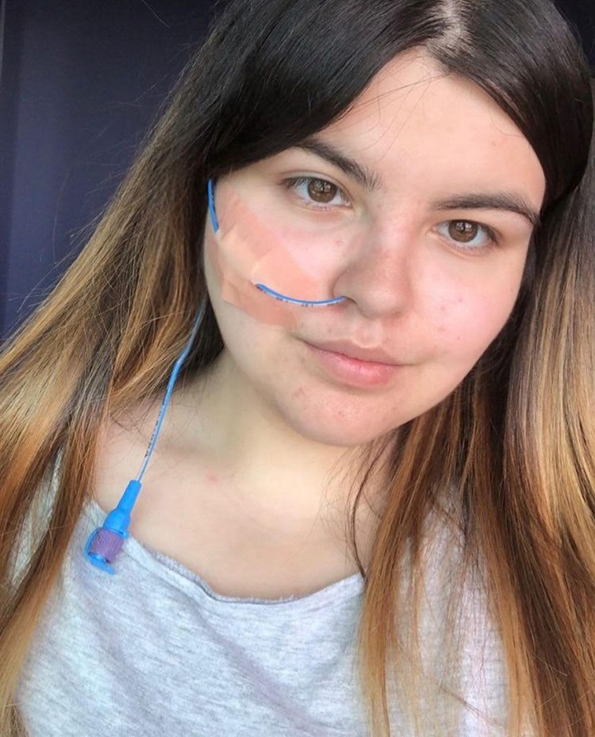 A teenager in hospital with a tube providing medicine through her nose