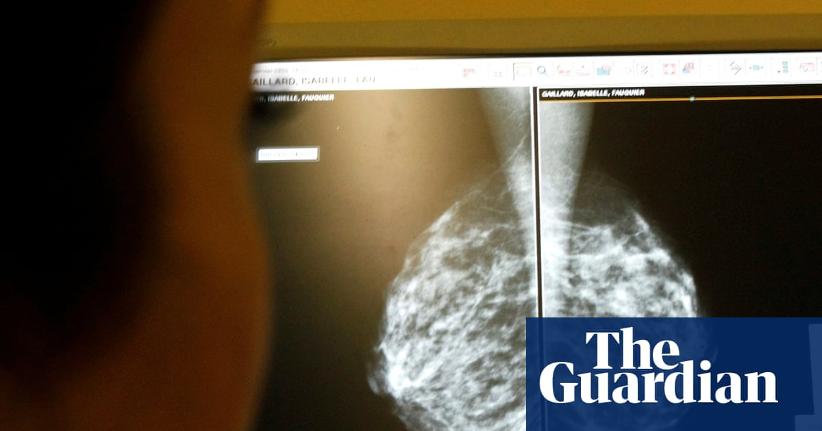 AI use in breast cancer screening cuts rate of later diagnosis by 12%, study finds | Cancer research