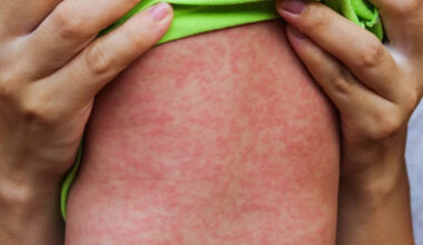 11 more measles cases confirmed in Manitoba during 1st full week of 2026