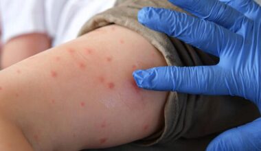 New measles case confirmed on flight from Madrid to Montreal | News