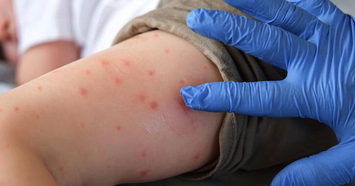 New measles case confirmed on flight from Madrid to Montreal | News