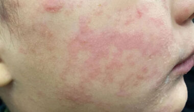 Experts call for a measles 'immunization action plan' in Ontario