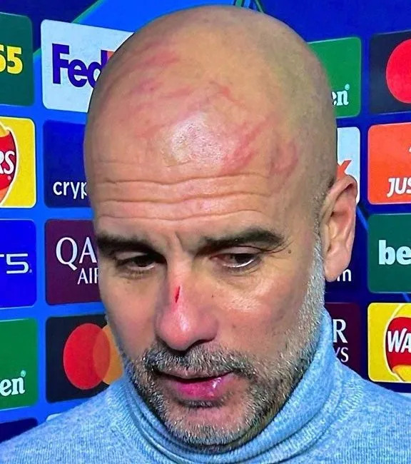 Guardiola with scratches on nose and forehead