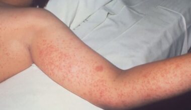 Possible measles exposure at NKY hotel, attraction
