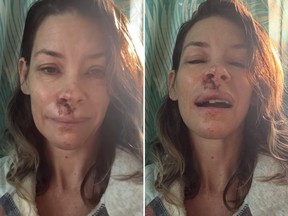 Canadian actress Evangeline Lilly shared these images of her face after she fainted and blacked out on a beach in Hawaii last May.