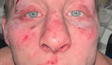 Dana White Shares Photo of Paddy Pimblett’s Battered Face
