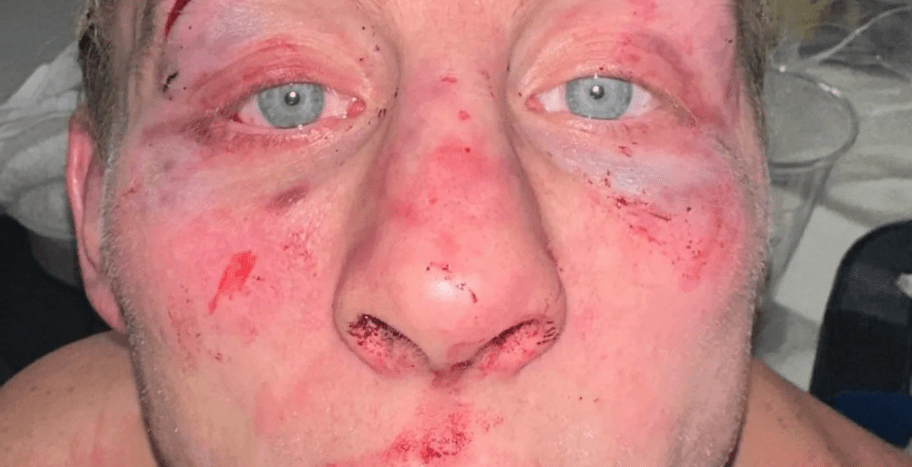 Dana White Shares Photo of Paddy Pimblett’s Battered Face