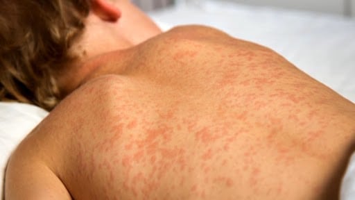 18 more measles cases, 4 new exposure sites confirmed in Manitoba