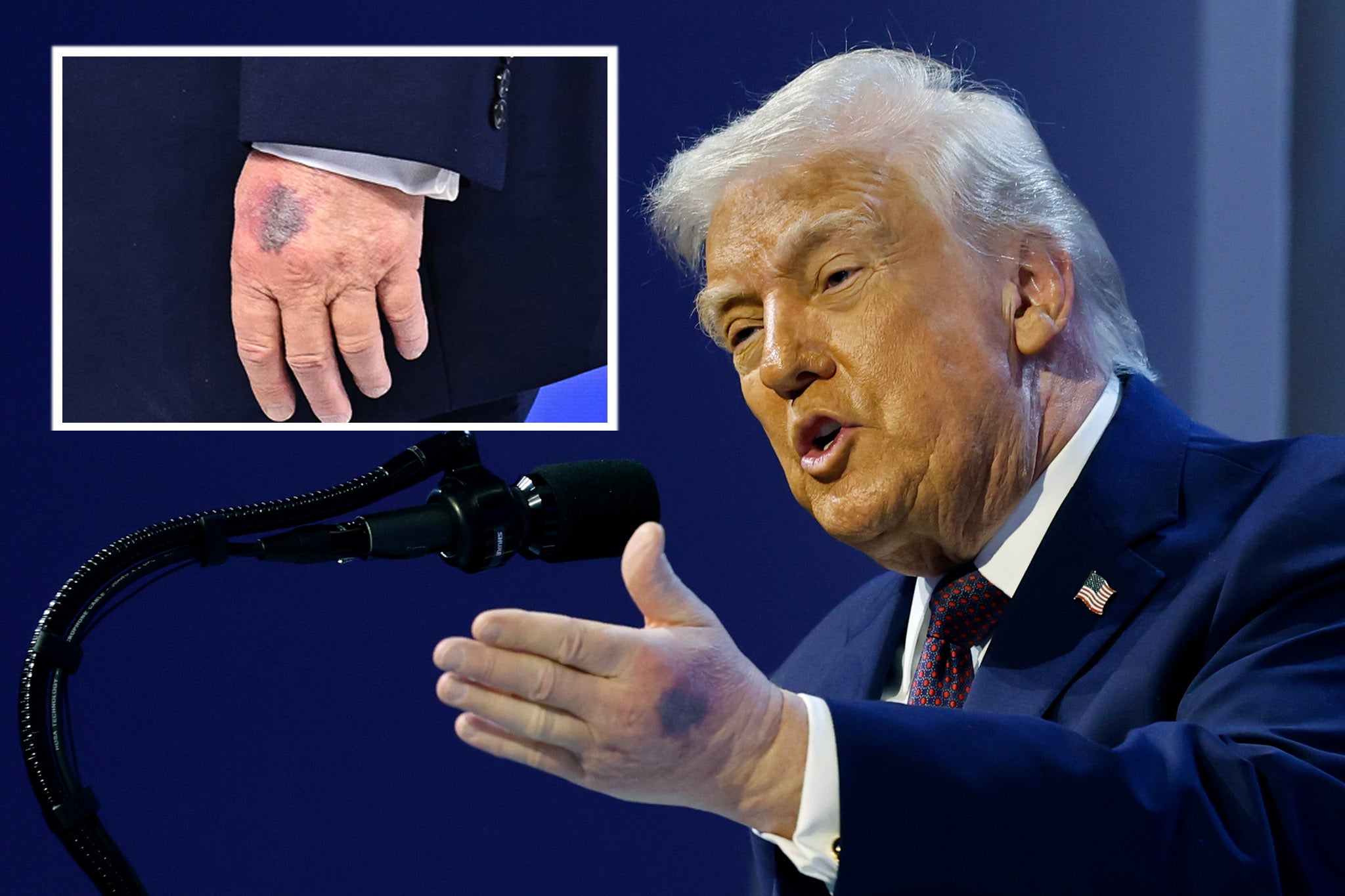 Donald Trump was seen with extensive bruising on his hand at Davos, which he says was caused by “the big Aspirin”