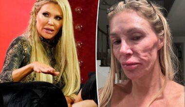 Brandi Glanville shares exorbitant cost of trying to figure out facial parasite mystery