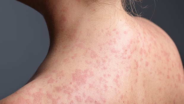 Manitoba still faces challenge in curbing measles a year into outbreak: community health prof