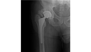 Key Proteins Found to Drive Abnormal Bone Growth After Injury