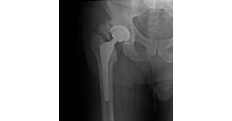 Key Proteins Found to Drive Abnormal Bone Growth After Injury