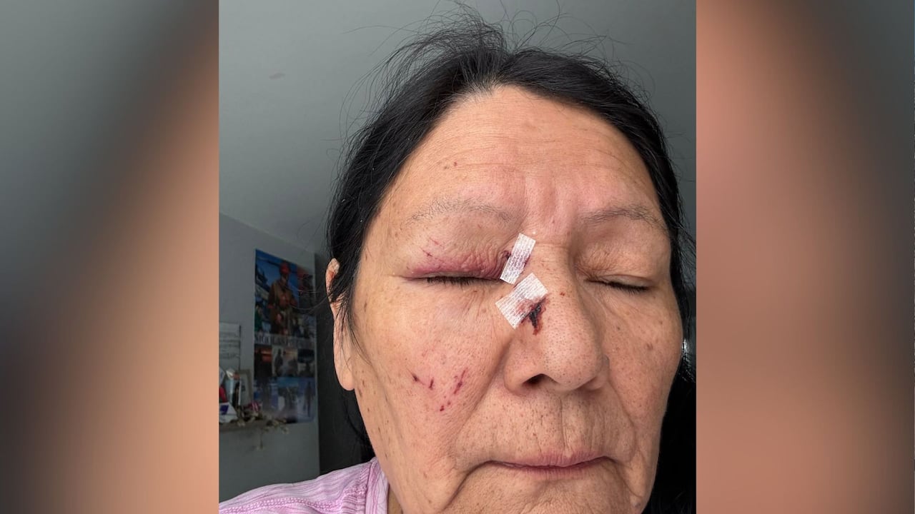 A woman with a bandaged cut on her face