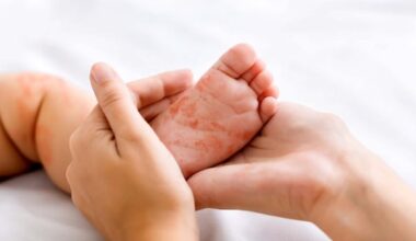 Measles cases skyrocket in Manitoba with 139 in February alone