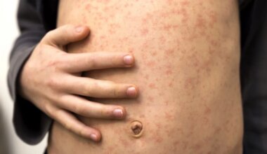 Shopper’s Mall, Sportsplex Pool among possible measles exposure sites