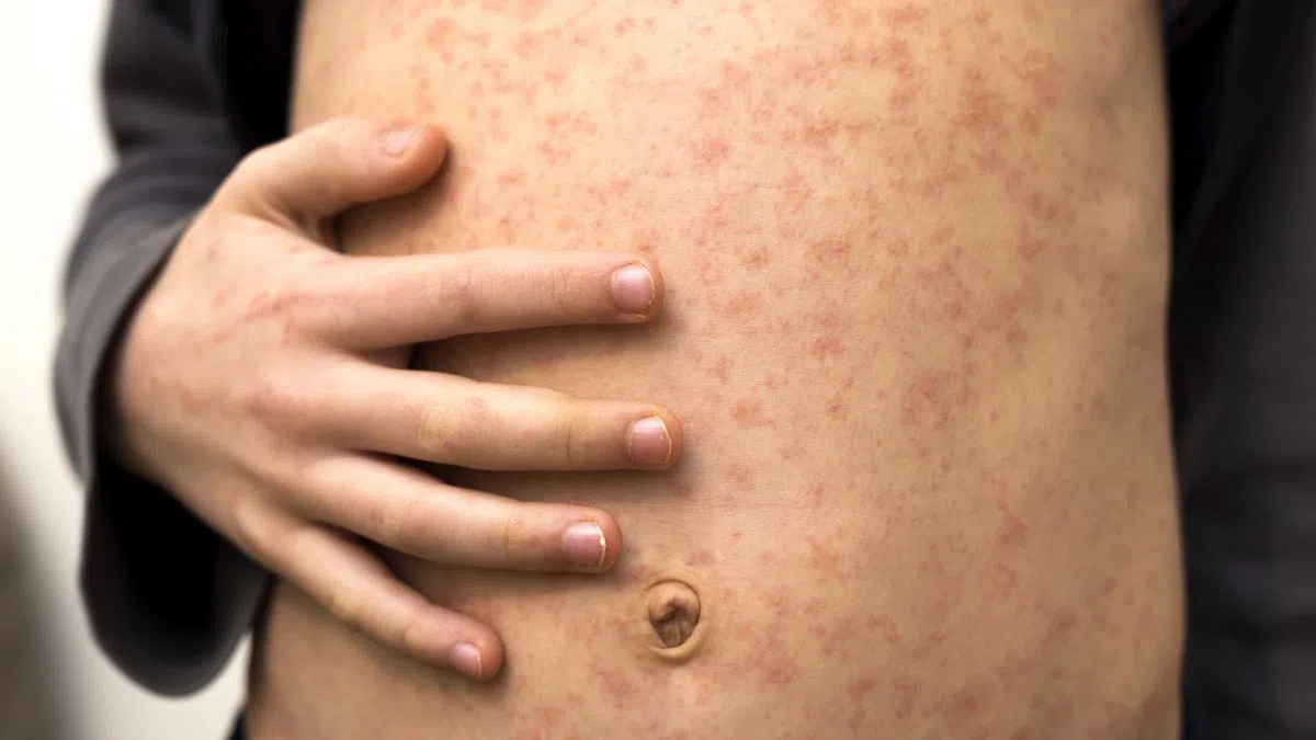 Shopper’s Mall, Sportsplex Pool among possible measles exposure sites