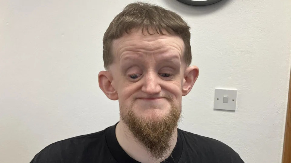 A man with short brown hair and a beard is part-smiling at the camera. He is blind so his eyes look as though he is looking downwards