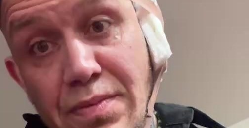 MMA fighter who got his ear chewed off a la Tyson-Holyfield posts grisly recovery pics (NSFW)