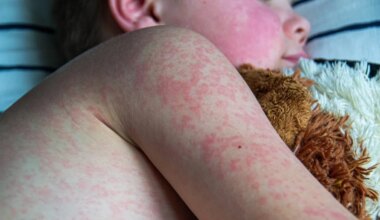 Cases rise in Edmonton as Alberta struggles to shake measles outbreak | play 103.7