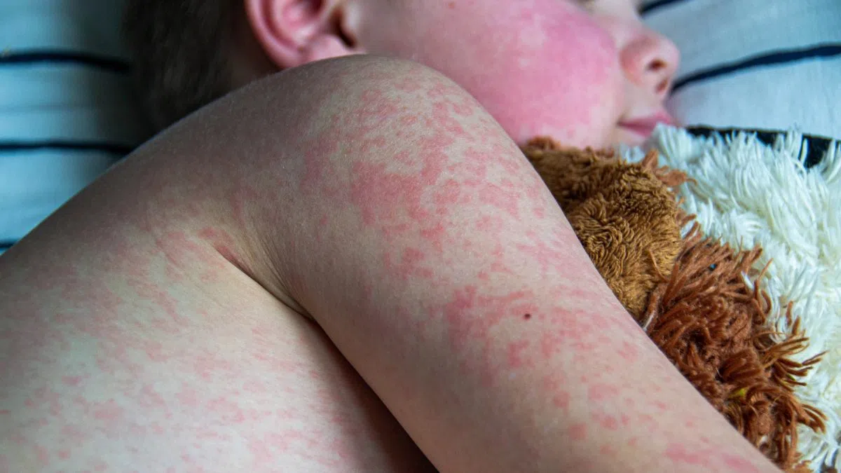 Cases rise in Edmonton as Alberta struggles to shake measles outbreak | play 103.7