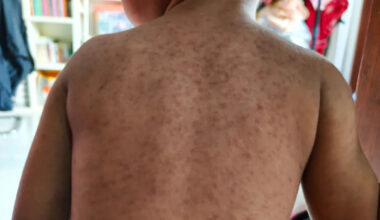 Measles outbreak could see unvaccinated pupils excluded from schools in north London