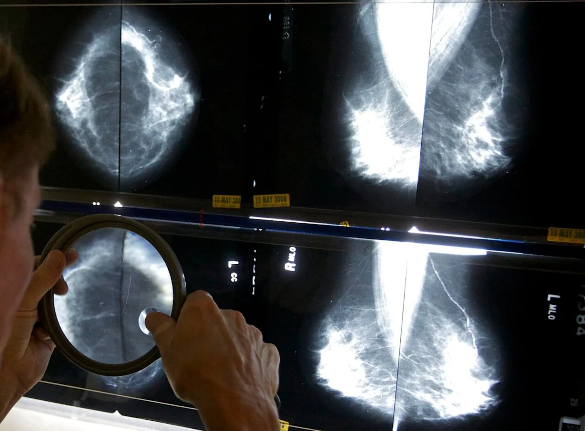 Research highlights disparities in breast cancer care for Black women in Canada