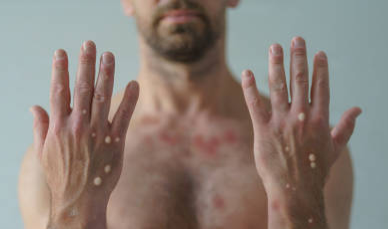 Tpoxx doesn’t improve on placebo in achieving key mpox outcomes, phase 3 trial concludes