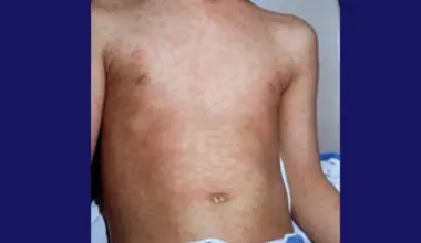 A red blotchy measles rash, which develops on the face and spreads down the body about three to seven days after symptoms begin. (Health Canada website)