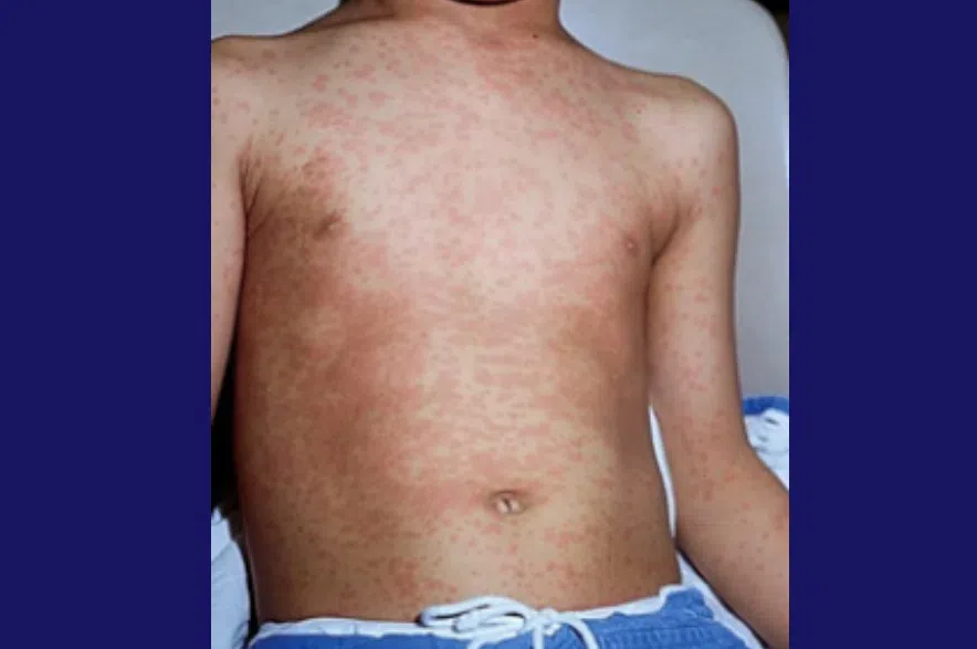 A red blotchy measles rash, which develops on the face and spreads down the body about three to seven days after symptoms begin. (Health Canada website)