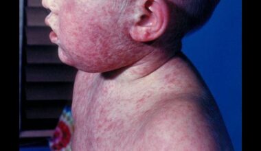 The measles vaccine: A product of two centuries of science and public health reform