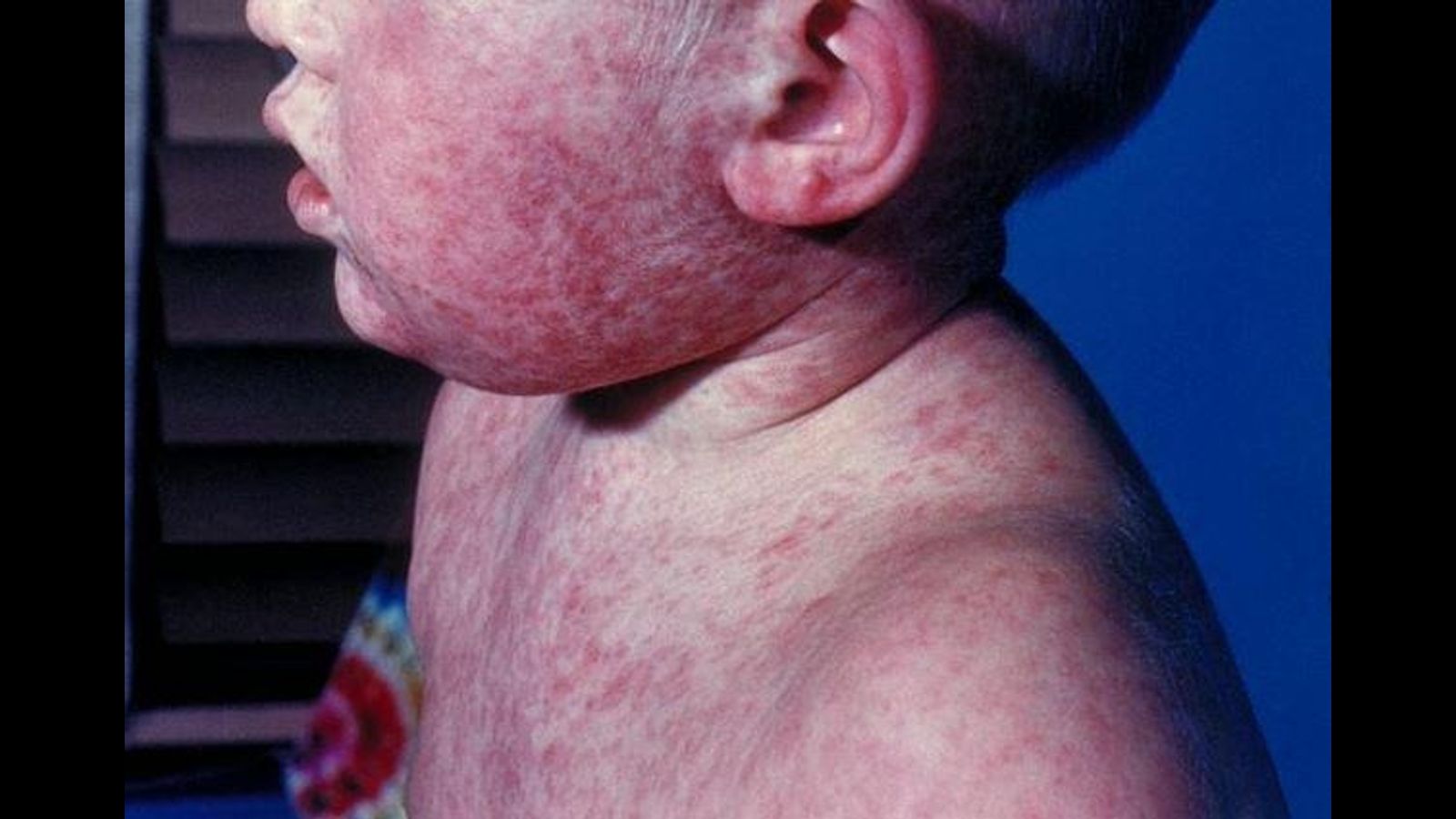 The measles vaccine: A product of two centuries of science and public health reform