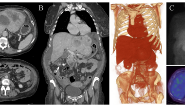 Multivalvular Cardiac Involvement from Giant Hepatic Metastases of an Ileal Neuroendocrine Tumor