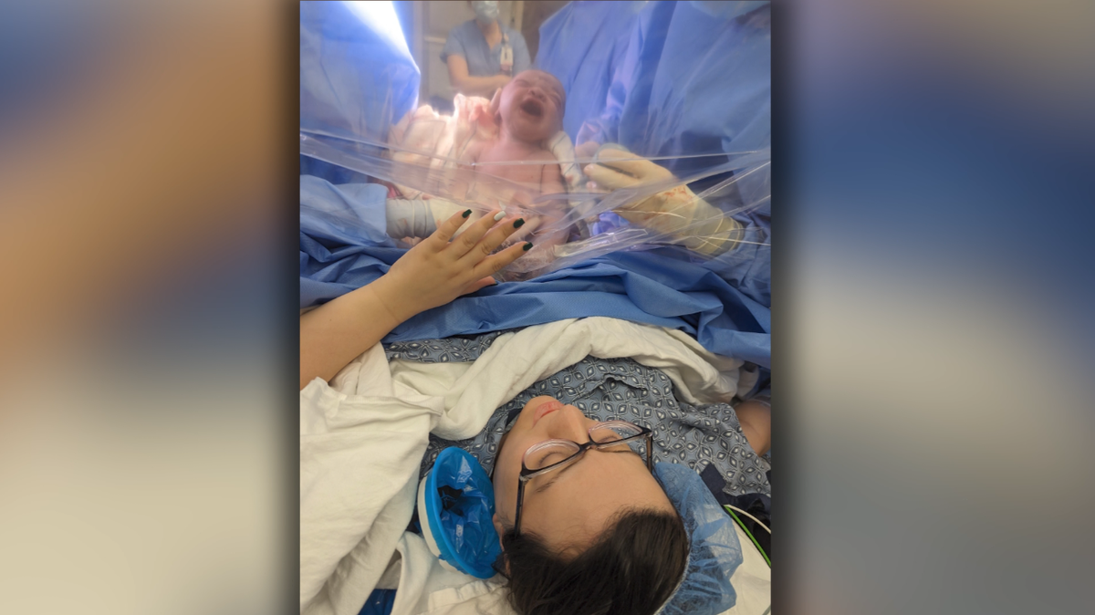 Unplanned C-section doubles risk of 'severe psychological stress' for new moms