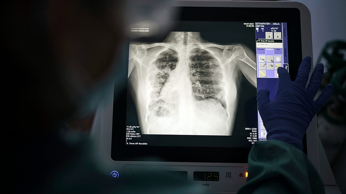 Europe misses 1 out of 5 tuberculosis cases as drug resistance rises, health agencies warn